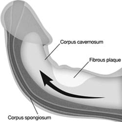 Curved Penis Syndrome or Peyronies
