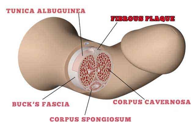 Penis Structure With Fibrous Plaque Causing Peyronies Disease