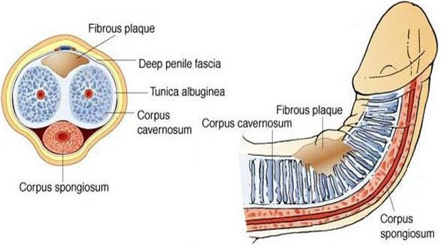Peyronies Disease Due To Plaque Formation