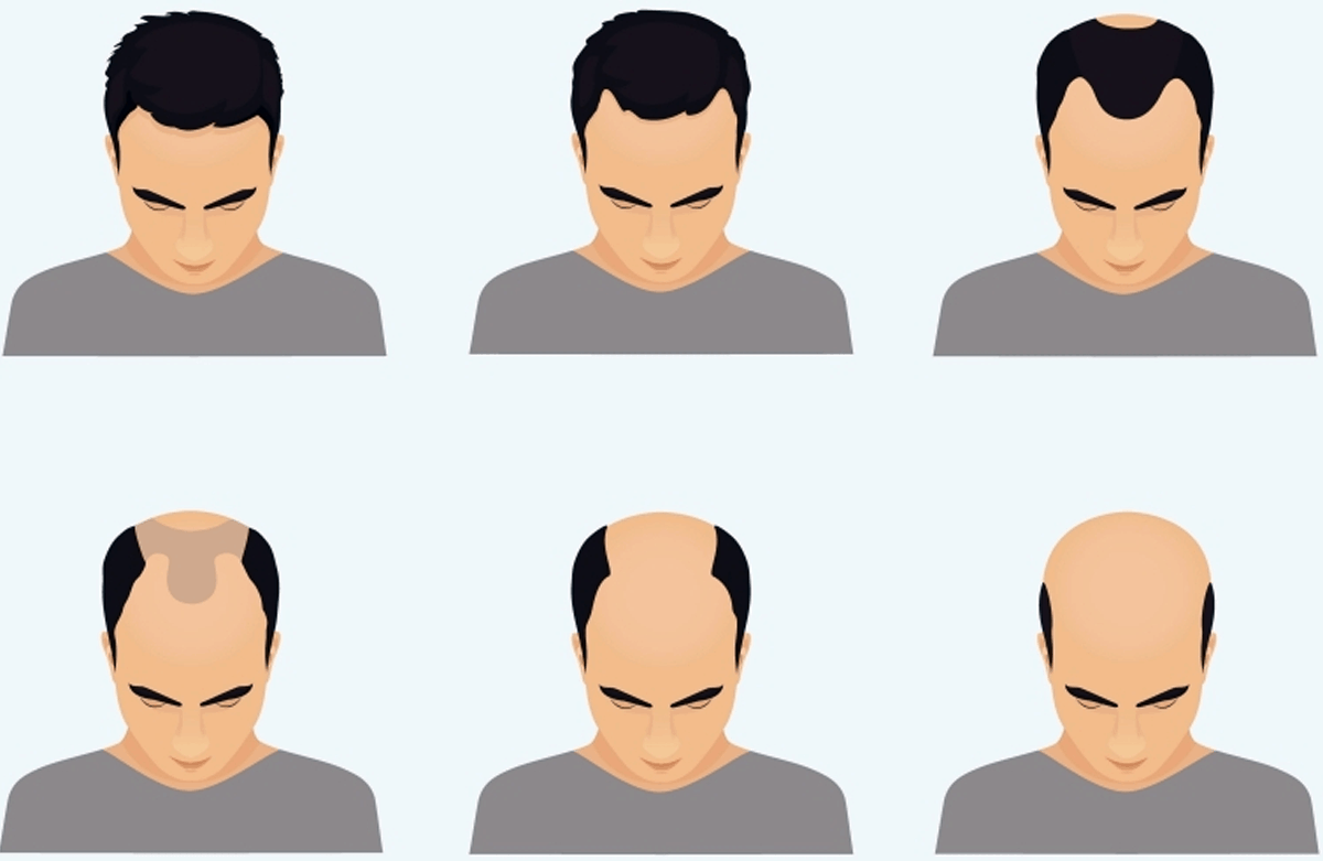 Hair Loss Stages In Men